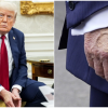 Trump hidap penyakit urat kronik