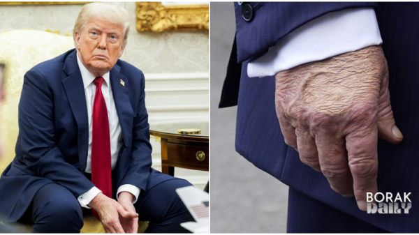 Trump hidap penyakit urat kronik