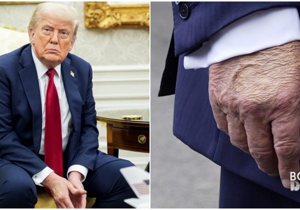 Trump hidap penyakit urat kronik