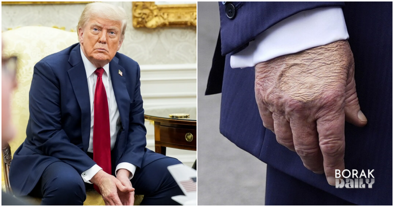 Trump hidap penyakit urat kronik